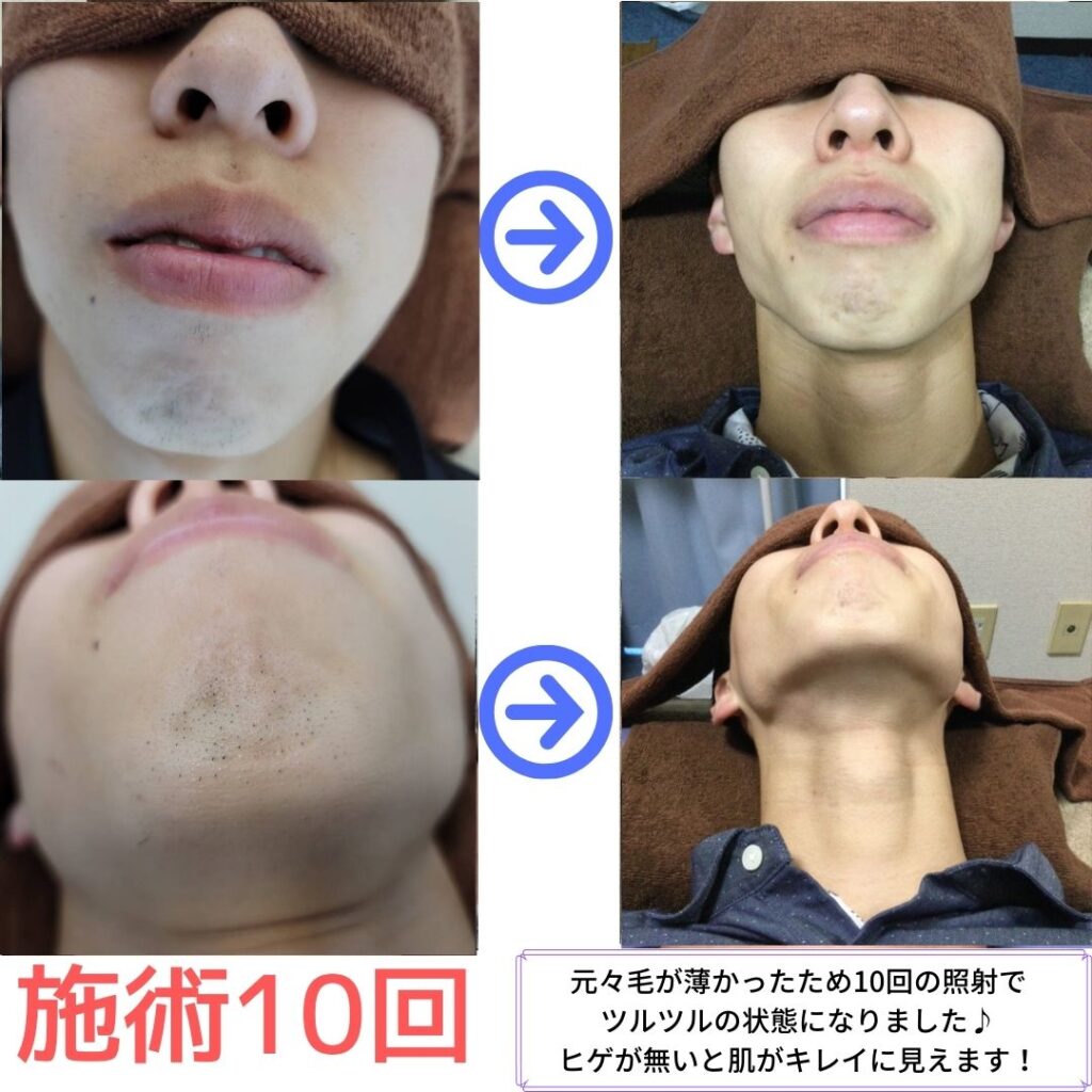 ヒゲ脱毛　効果